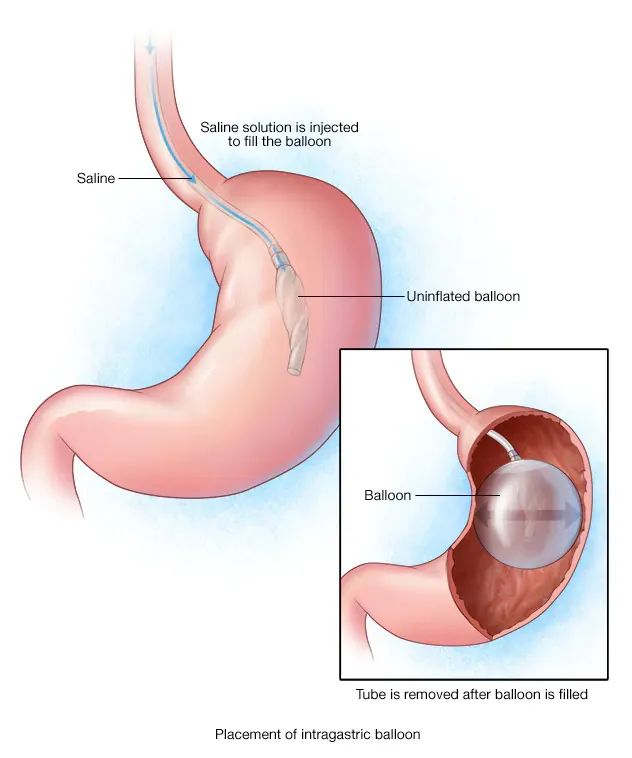 intragastric-balloon-8col.webp